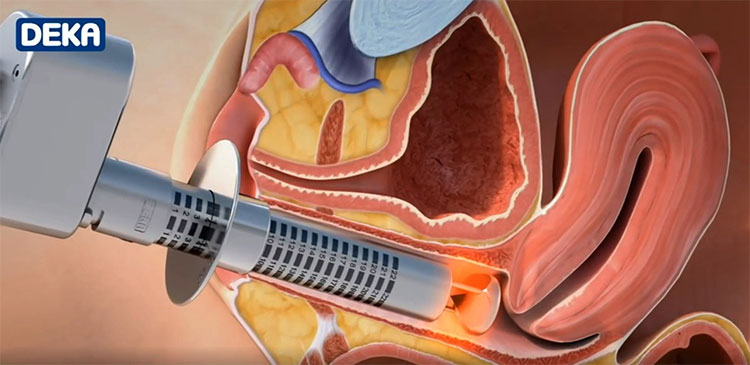 モナリザタッチ施術当日